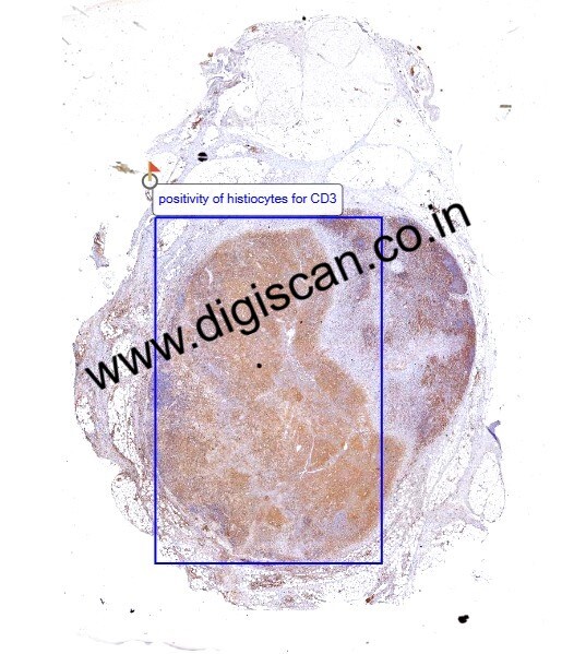 MDS Immunohistochemistry (IHC) Digital Slides Set